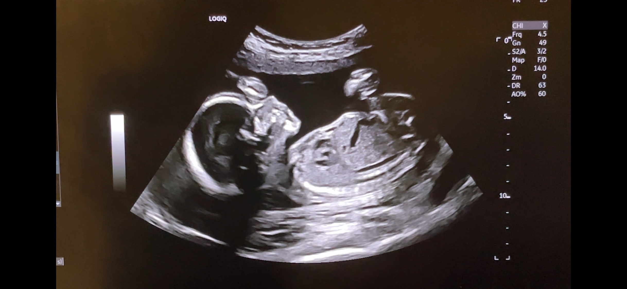 Ultrasound image